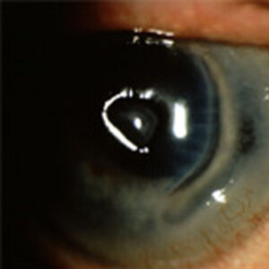 Performing LASIK on autoimmune patients may not be as risky as once thought