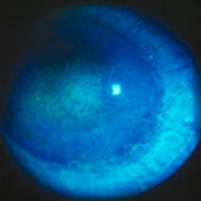 A reprieve for dry eye patients