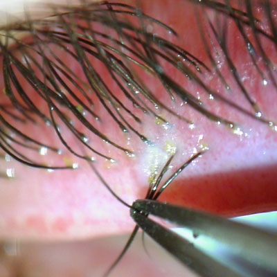 Demodex treatment options