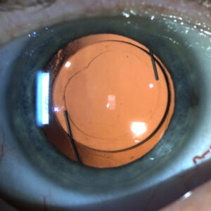 What to know about the Light Adjustable Lens