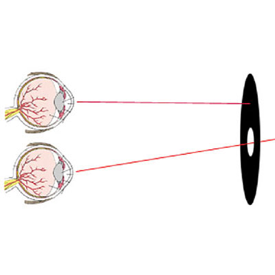 Choosing between monovision and multifocals