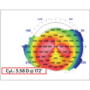 Prepping the ocular surface for cataract surgery