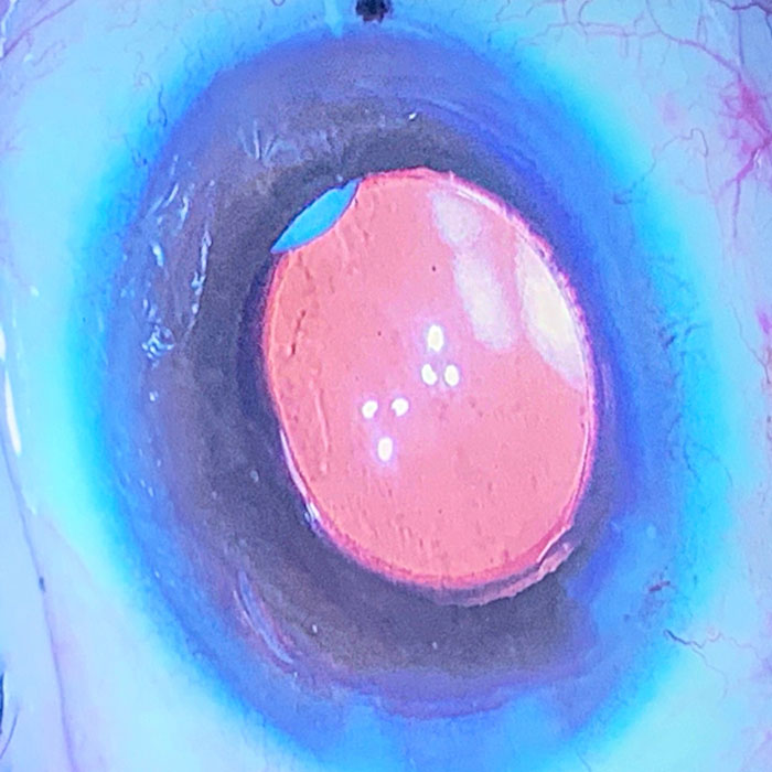 Cataract postop regimens examined